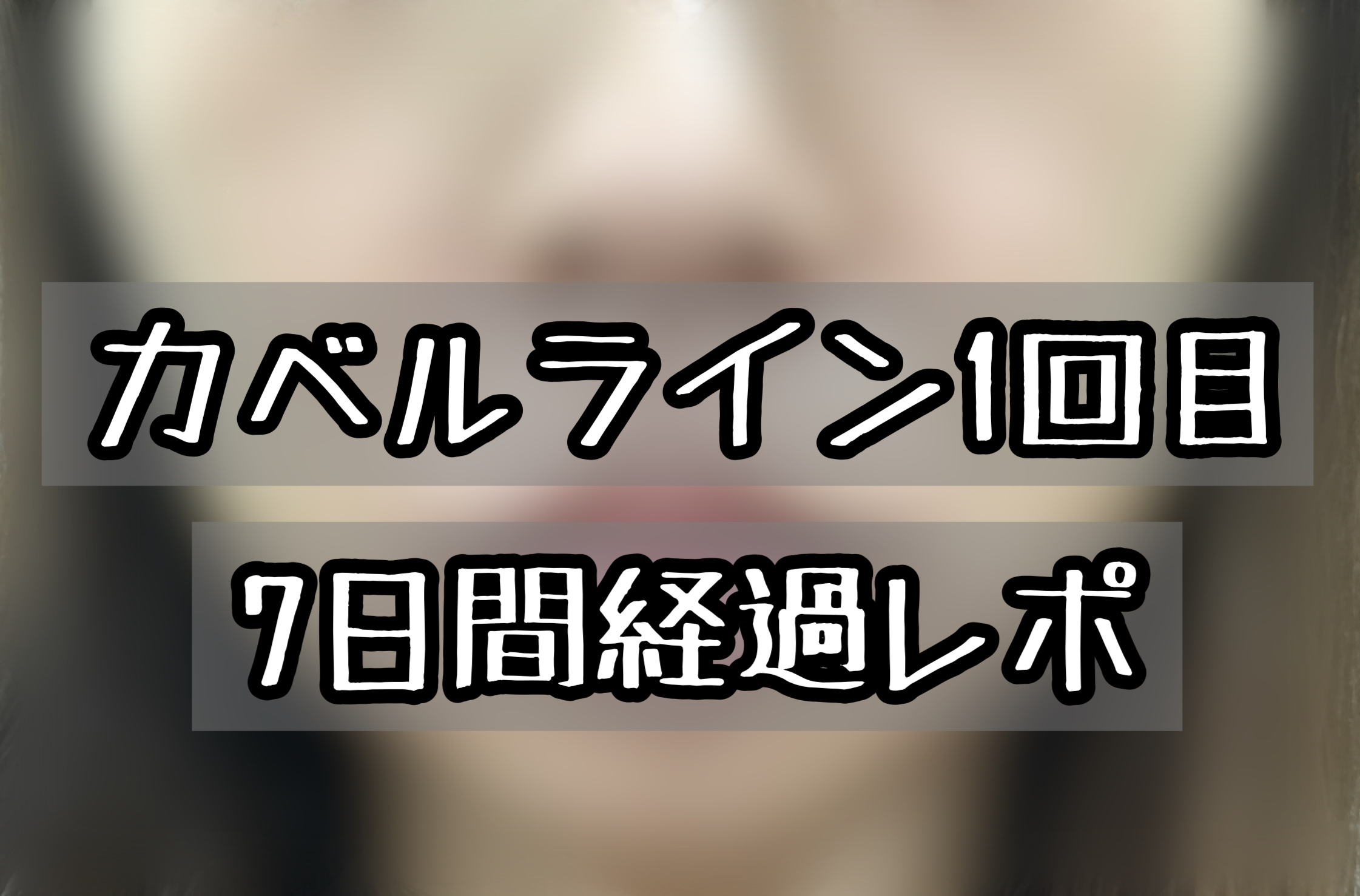カベルライン1回目経過ブログ Bnlsより腫れる 写真で7日間を振り返る メメコメモ カベルライン1回目経過ブログ Bnlsより腫れる 写真で7日間を振り返る メメコメモ