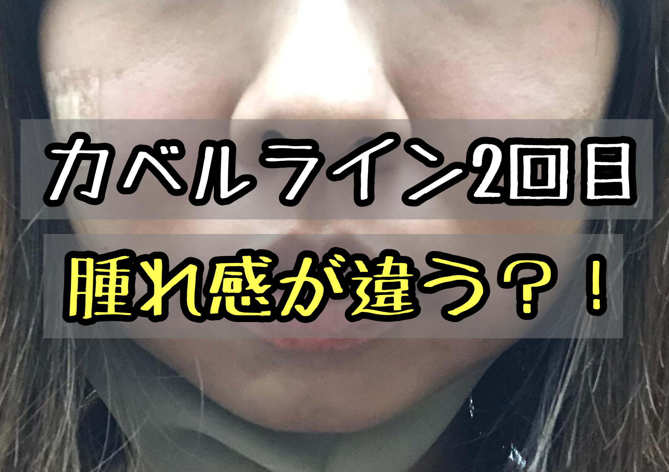 カベルライン2回目を打ってきた体験談ブログ 1回目と腫れ感が違う メメコメモ カベルライン2回目を打ってきた体験談ブログ 1回目と腫れ感が違う メメコメモ