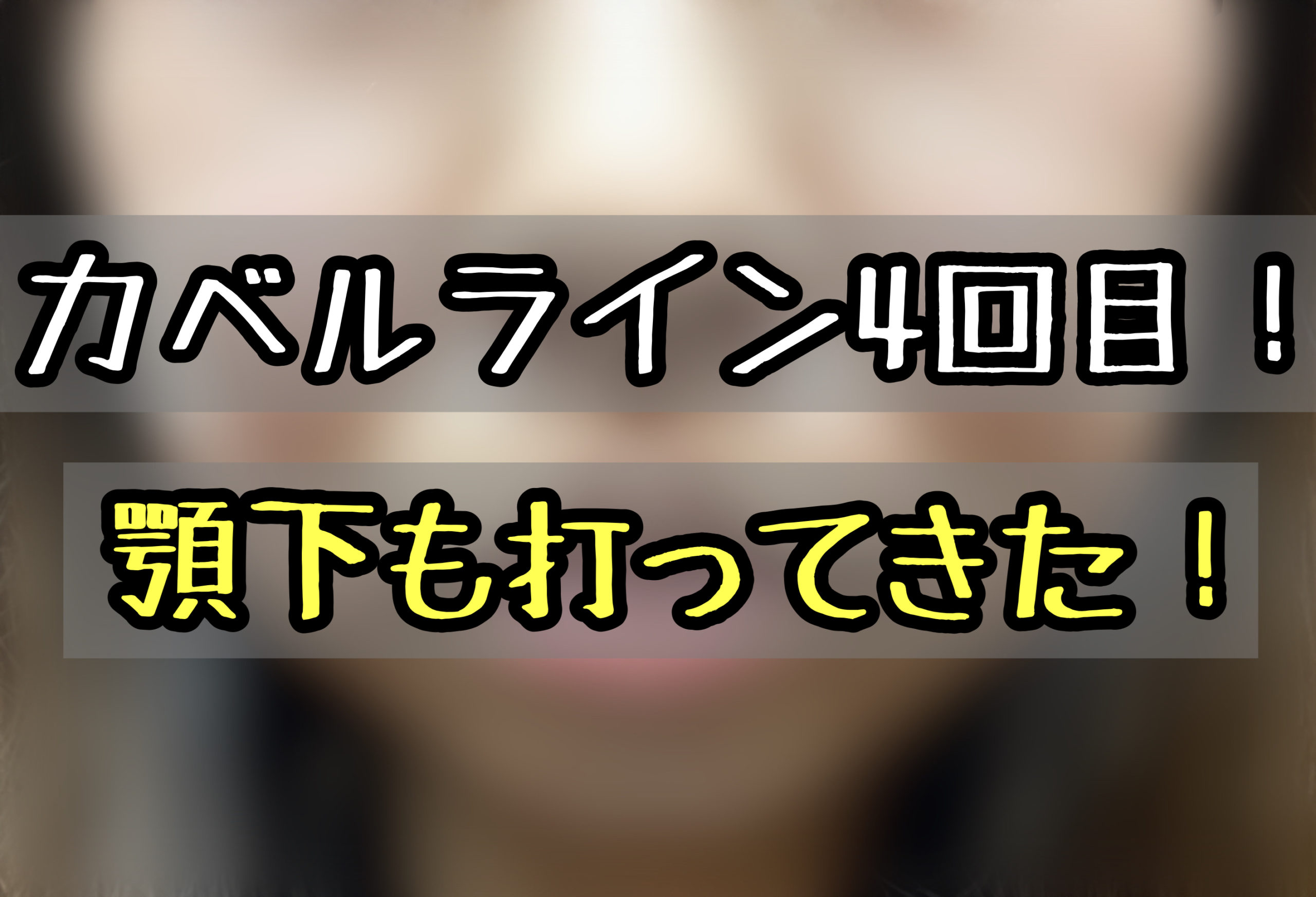 カベルライン4回目体験ブログ 追加で顎下にも打ってきちゃいました メメコメモ