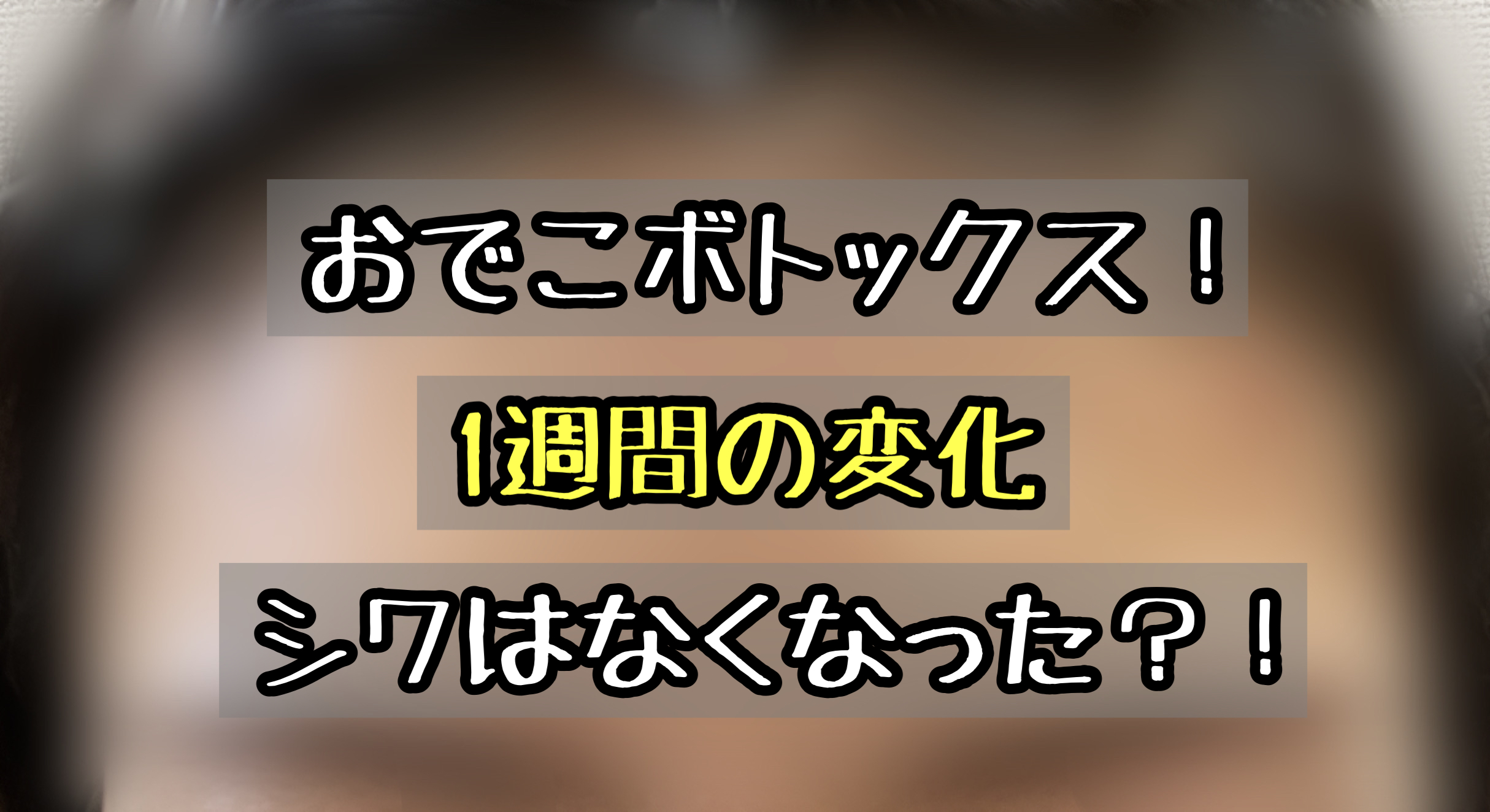 おでこボトックスその後の経過ブログ 額にしわはできなくなったのか メメコメモ