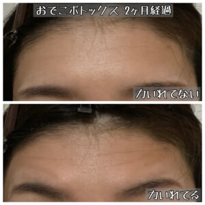 おでこのボトックス注射 2ヶ月経過したら効果ない 写真で検証します メメコメモ