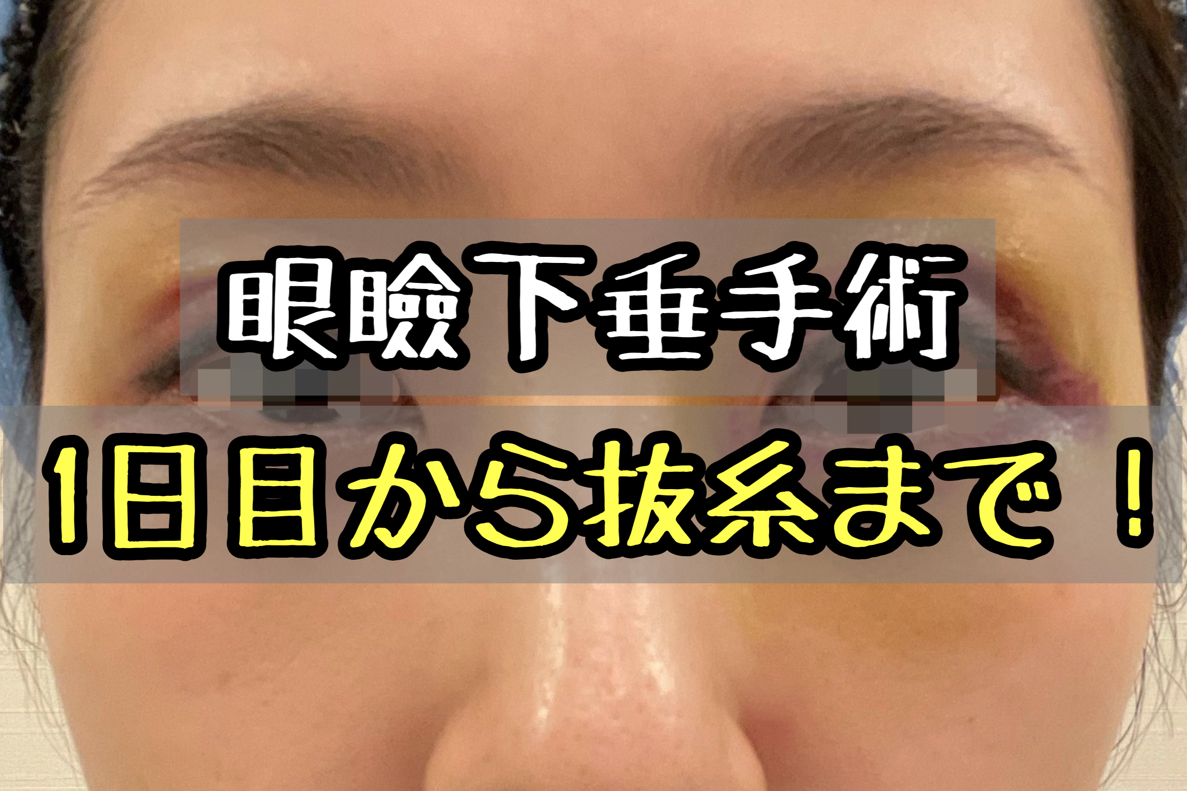 眼瞼下垂手術のダウンタイム経過ブログ 抜糸までの1週間の画像公開 メメコメモ 眼瞼下垂手術のダウンタイム経過ブログ 抜糸までの1週間の画像公開 メメコメモ