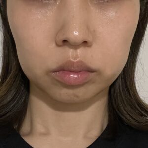 バッカルファット除去のダウンタイム経過ブログ 22日目から31日目までを写真でレポ メメコメモ バッカルファット除去のダウンタイム経過ブログ 22日目から31日目までを写真でレポ メメコメモ